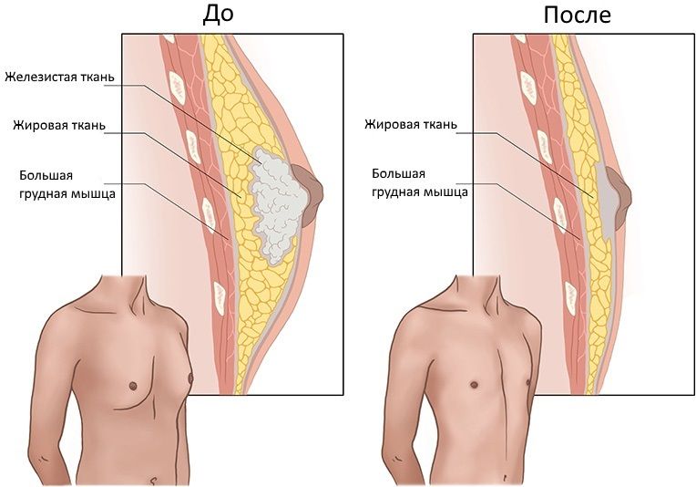 До і Після операції по видаленню гінекомастії (схематичний вид)